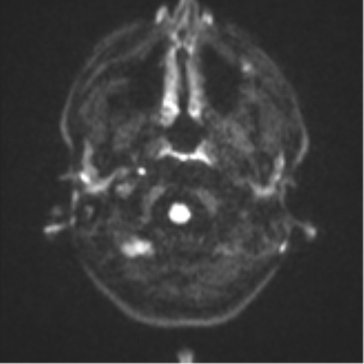 Anaplastic astrocytoma (Radiopaedia 57768-64731 Axial DWI 29).png