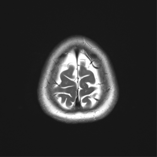 File:Anaplastic astrocytoma (Radiopaedia 86943-103160 Axial T2 35).png