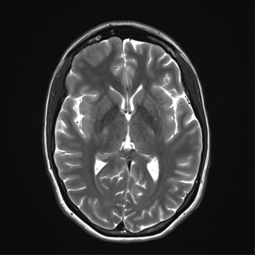 File:Anaplastic astrocytoma IDH mutant (Radiopaedia 50046-55341 Axial T2 20).png