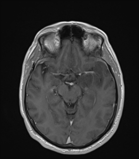 Anaplastic astrocytoma IDH wild-type (Radiopaedia 49984-55273 Axial T1 C+ 25).png