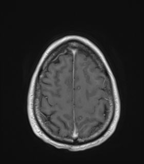 Anaplastic astrocytoma IDH wild-type (Radiopaedia 49984-55273 Axial T1 C+ 47).png