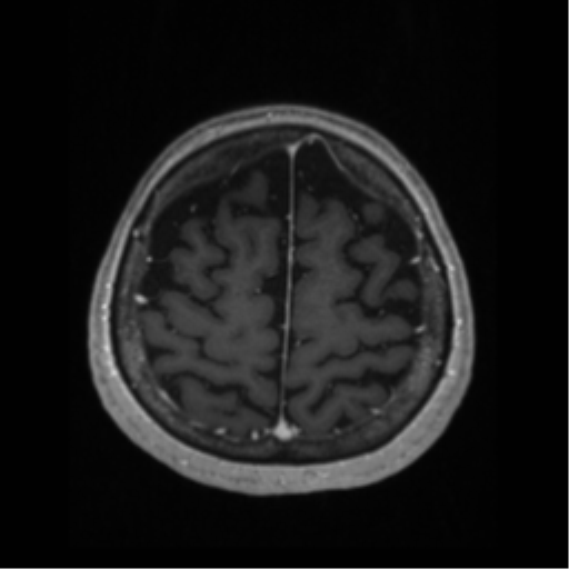 File:Anaplastic astrocytoma IDH wild-type (pseudoprogression) (Radiopaedia 42209-45276 Axial T1 C+ 120).png