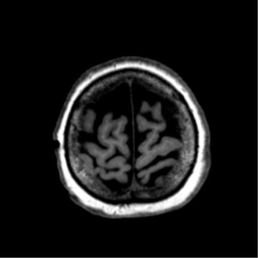 Anaplastic astrocytoma IDH wild-type (pseudoprogression) (Radiopaedia 42209-45277 Axial T1 118).png