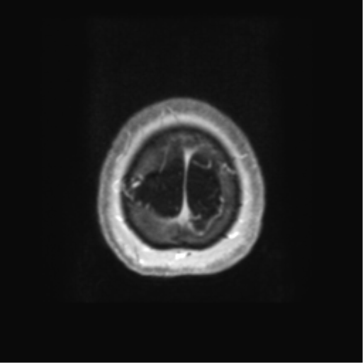 Anaplastic astrocytoma IDH wild-type (pseudoprogression) (Radiopaedia 42209-45279 Axial T1 C+ 135).png