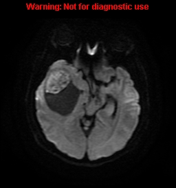 File:Anaplastic ganglioglioma (Radiopaedia 44921-48831 Axial DWI 11).jpg