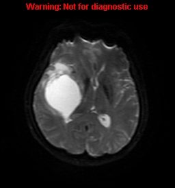 File:Anaplastic ganglioglioma (Radiopaedia 44921-48831 Axial DWI 47).jpg