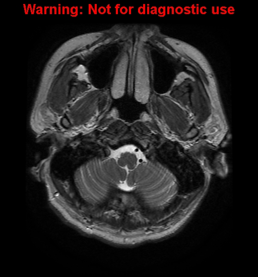 File:Anaplastic ganglioglioma (Radiopaedia 44921-48831 Axial T2 3).jpg