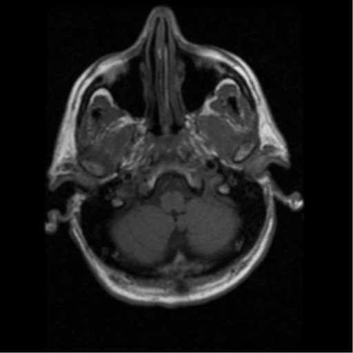 File:Anaplastic meningioma with recurrence (Radiopaedia 34452-35783 Axial T1 2).png