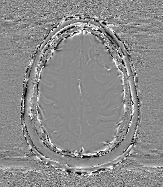 Anaplastic oligodendroglioma (Radiopaedia 83500-98599 Axial SWI - phase 67).png