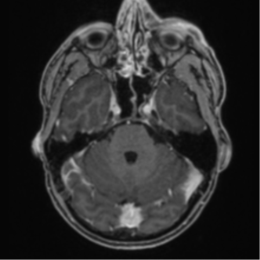 Anaplastic oligodendroglioma with skull fracture (Radiopaedia 74831-85845 Axial T1 C+ fat sat 15).png