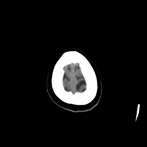 Aneursym related subarachnoid hemorrhage with hydrocephalus (Radiopaedia 45105-49083 Axial non-contrast 49).jpg