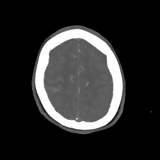 Aneursym related subarachnoid hemorrhage with hydrocephalus (Radiopaedia 45105-49084 A 53).jpg
