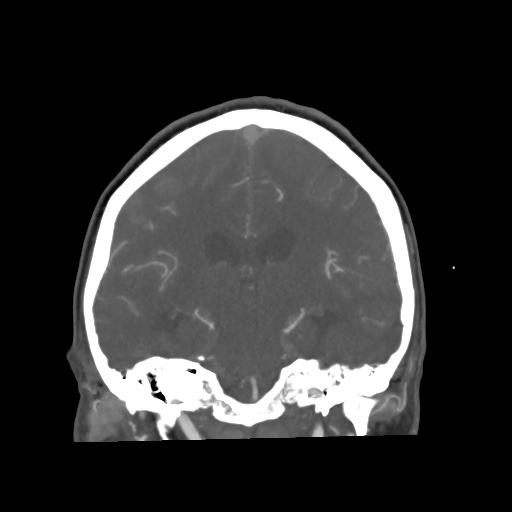 File:Aneursym related subarachnoid hemorrhage with hydrocephalus (Radiopaedia 45105-49084 B 46).jpg