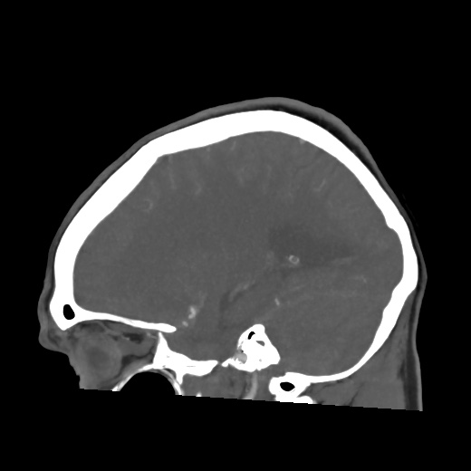 Aneursym related subarachnoid hemorrhage with hydrocephalus (Radiopaedia 45105-49084 C 49).jpg