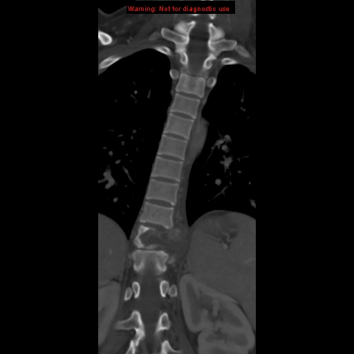 File:Aneurysmal bone cyst (Radiopaedia 9419-10102 Coronal bone window 10).jpg