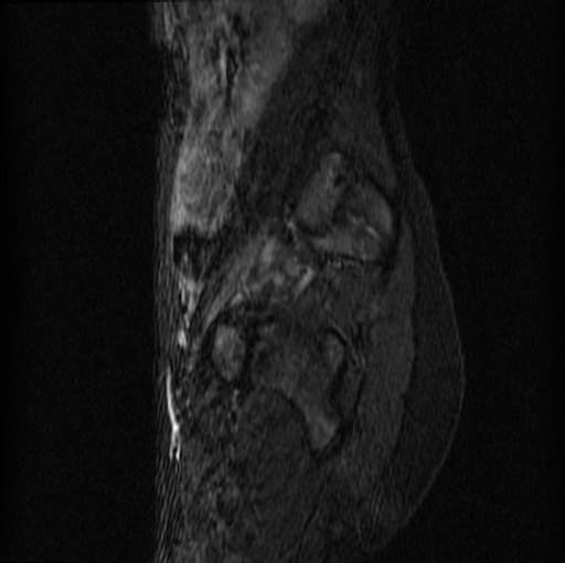File:Aneurysmal bone cyst - sacrum (Radiopaedia 65190-74196 Sagittal STIR 24).jpg