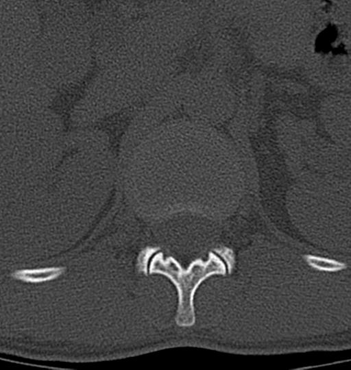 Aneurysmal bone cyst T11 (Radiopaedia 29294-29721 Axial bone window 59).jpg