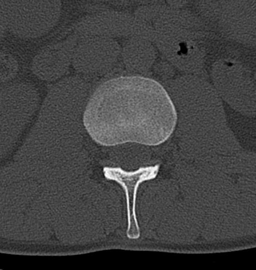 Aneurysmal bone cyst T11 (Radiopaedia 29294-29721 Axial bone window 80).jpg