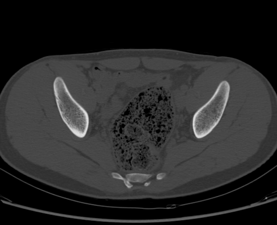 File:Aneurysmal bone cyst of ischium (Radiopaedia 25957-26094 Axial bone window 41).png