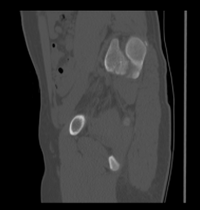 Aneurysmal bone cyst of ischium (Radiopaedia 25957-26094 Sagittal bone window 27).png