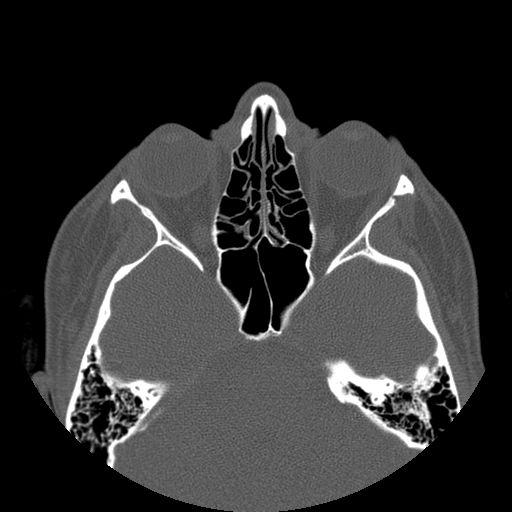 Aneurysmal bone cyst of the mandible (Radiopaedia 43280-46823 Axial bone window 166).jpg