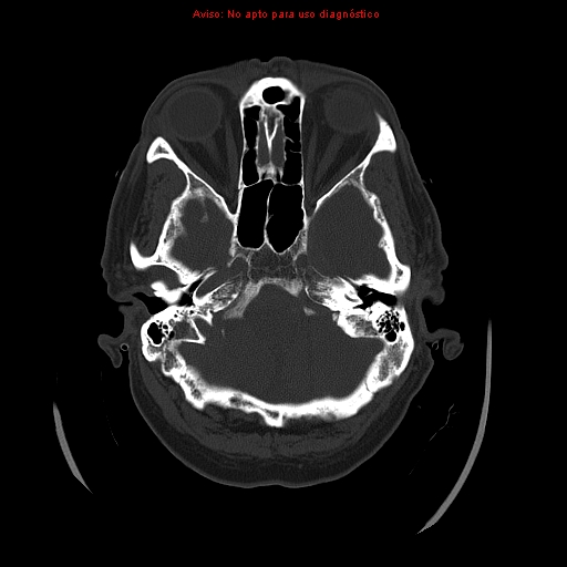 File:Aneurysmal subarachnoid hemorrhage (Radiopaedia 24740-24997 bone window 8).jpg