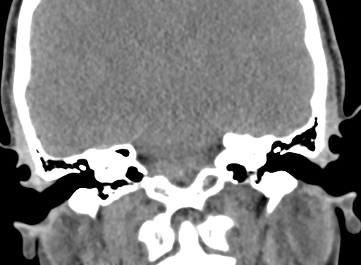 Angular dermoid cyst (Radiopaedia 88967-105790 Coronal non-contrast 75).jpg