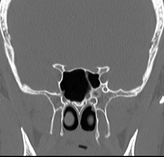Angular epidermoid cyst (Radiopaedia 46908-51439 Coronal bone window 43).png