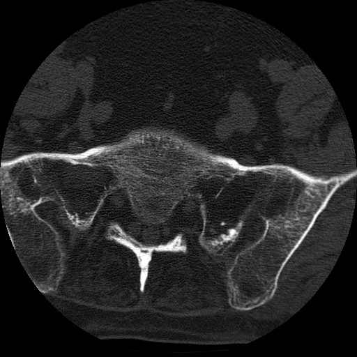 Ankylosing spondylitis complicated by fracture-dislocation (Radiopaedia 33583-34674 Axial non-contrast 158).jpg
