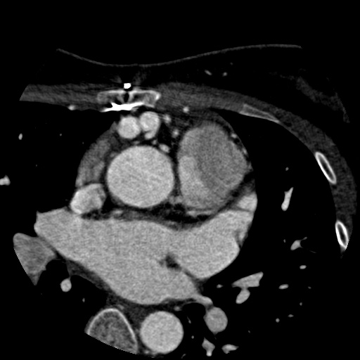 Anomalous left coronary artery from the pulmonary artery (ALCAPA) (Radiopaedia 40884-43586 A 13).jpg