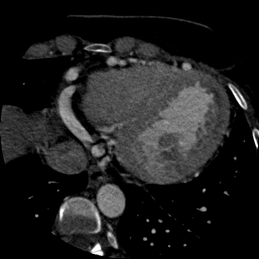 File:Anomalous left coronary artery from the pulmonary artery (ALCAPA) (Radiopaedia 40884-43586 A 67).jpg