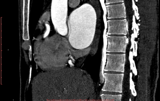 Anomalous left coronary artery from the pulmonary artery (ALCAPA) (Radiopaedia 70148-80181 C 92).jpg