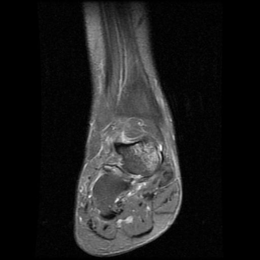 File:Anterior calcaneal process fracture (Radiopaedia 71377-81705 Coronal PD fat sat 4).jpg