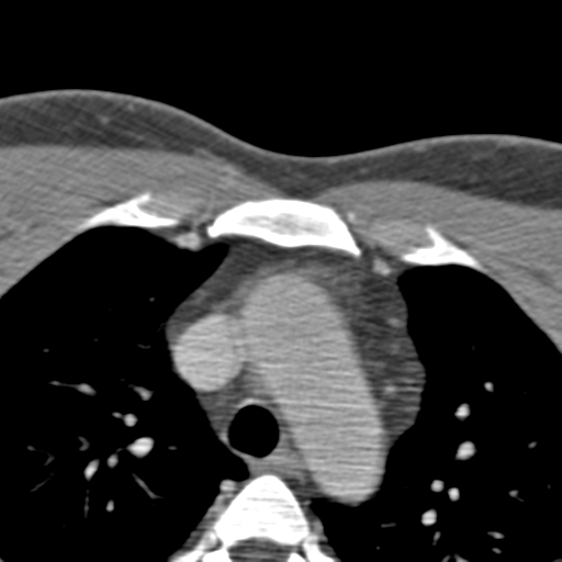 Anterior cerebral artery territory infarct (Radiopaedia 39327-41581 B 115).png