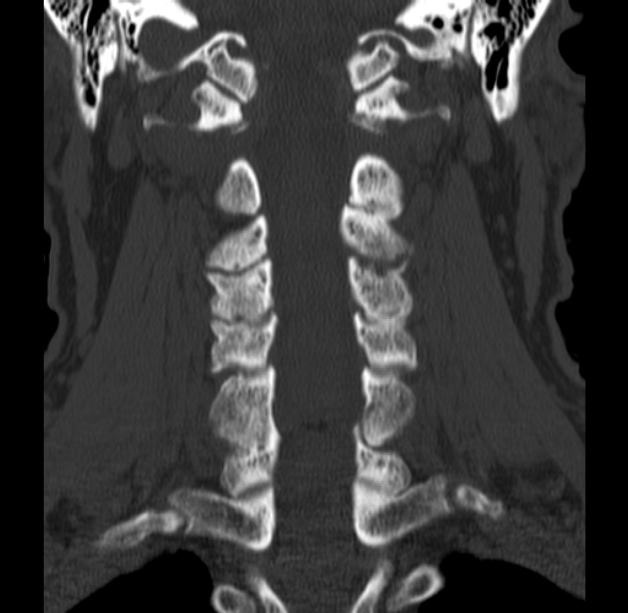 Anterior cervical postdiscectomy arthrodesis (Radiopaedia 32678-33646 Coronal bone window 37).jpg