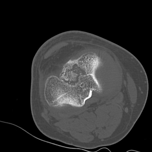 File:Anterior cruciate ligament avulsion fracture (Radiopaedia 58939-66194 Axial bone window 17).jpg
