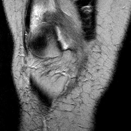 File:Anterior cruciate ligament mucoid degeneration (Radiopaedia 60853-68633 Coronal T2 8).jpg