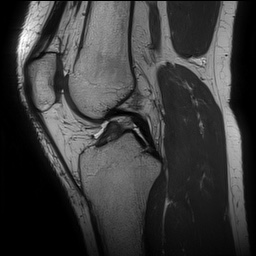 Anterior cruciate ligament rupture and posteromedial corner injury (Radiopaedia 67338-76723 Sagittal PD 82).jpg