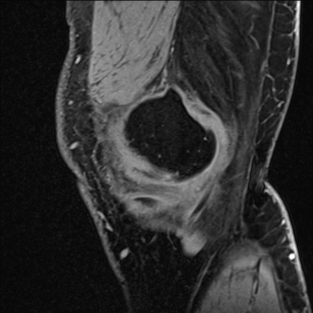 Anterior cruciate ligament tear - ramp lesion (Radiopaedia 71883-82322 Sagittal T1 vibe 120).jpg