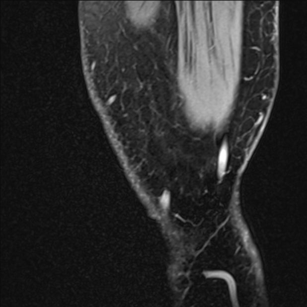Anterior cruciate ligament tear - ramp lesion (Radiopaedia 71883-82322 Sagittal T1 vibe 141).jpg