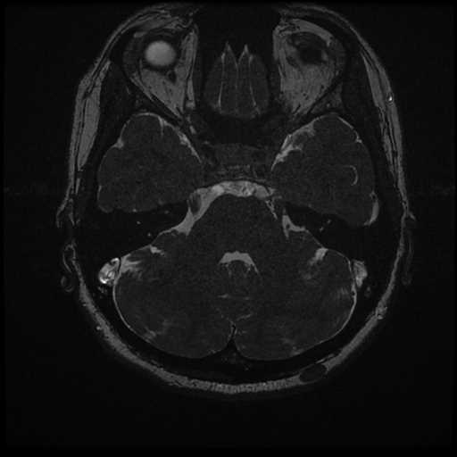 Anterior inferior cerebellar artery vascular loop - type II (Radiopaedia 70991-81209 Axial 3D FIESTA 22).jpg