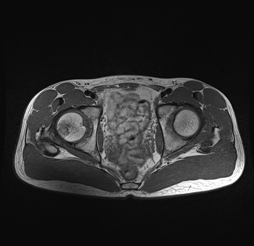 File:Anterior inferior iliac spine avulsion fracture (Radiopaedia 81312-95000 Axial T1 17).jpg