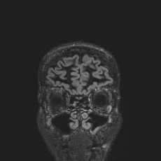 Anterior temporal encephalocele (Radiopaedia 82624-96808 Coronal FLAIR 6).jpg