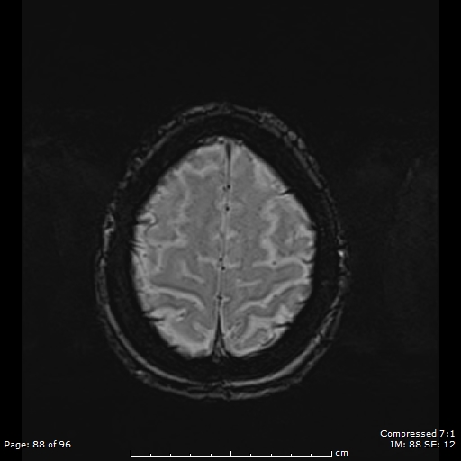 Anterior temporal lobe perivascular space (Radiopaedia 88283-104914 Axial SWI 57).jpg
