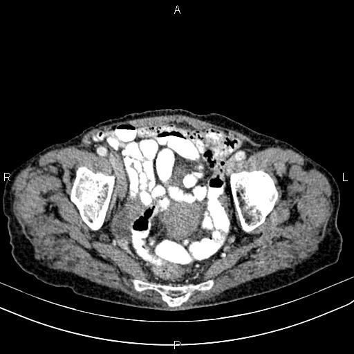 File:Aortic aneurysm and Lemmel syndrome (Radiopaedia 86499-102554 A 70).jpg