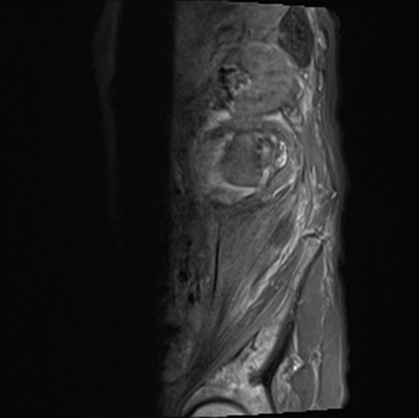 File:Aortic aneurysm with spinal destruction (Radiopaedia 42301-45409 Sagittal T1 fat sat 41).jpg