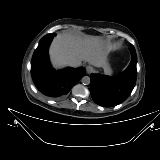 File:Aortic arch aneurysm (Radiopaedia 84109-99365 Axial non-contrast 236).jpg