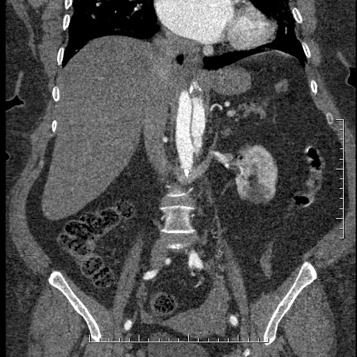 Aortic dissection- Stanford A (Radiopaedia 35729-37268 F 29).jpg
