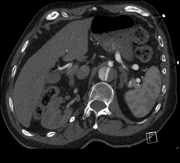 Aortic dissection (CTPA) (Radiopaedia 75506-86750 A 95).jpg