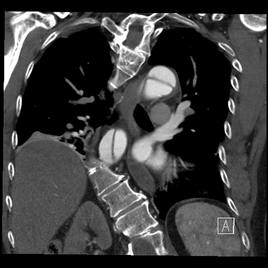 Aortic dissection (CTPA) (Radiopaedia 75506-86750 B 47).jpg